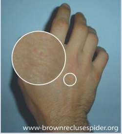 Black Widow Spider Bite